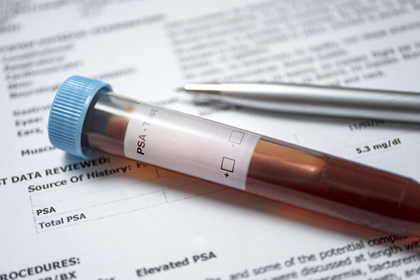 close-up photo of a vial of blood marked PSA test alongside a pen; both are resting on a document showing the PSA test results
